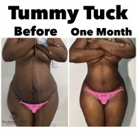 Tummy Tuck